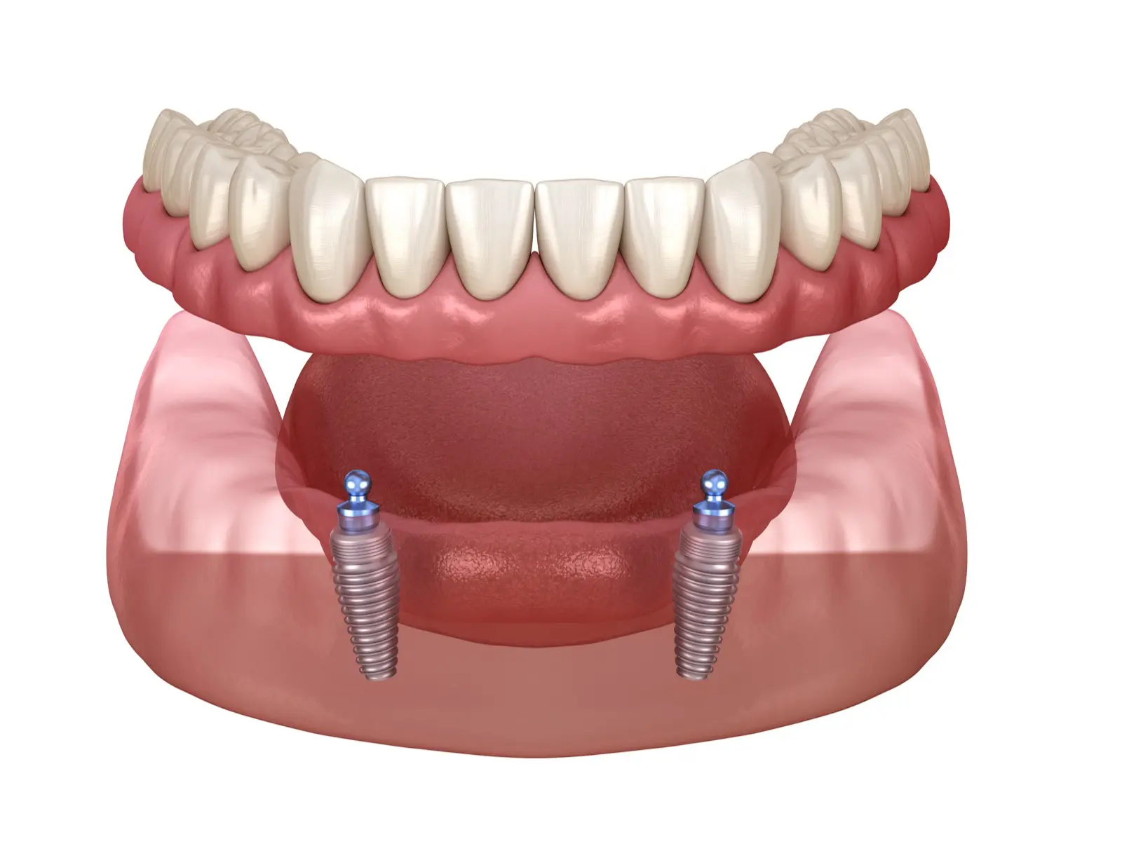Dentures vs. Dental Implants: Which Is Right for You?