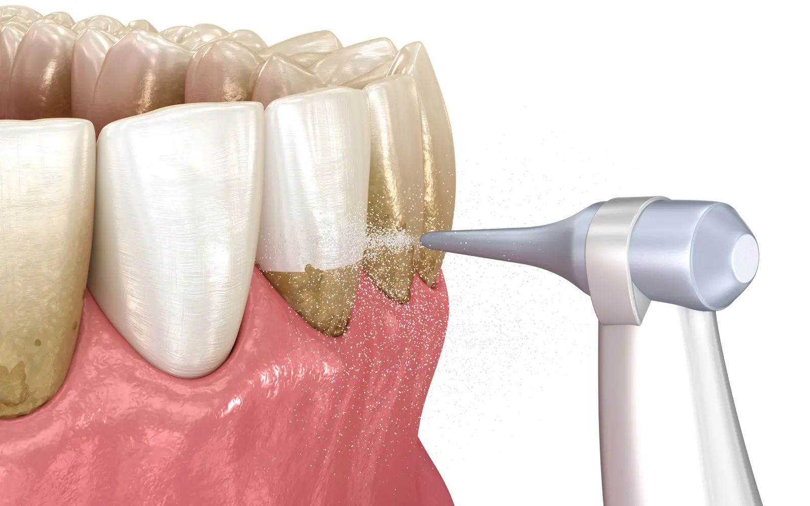Guided Biofilm Therapy: A Modern Approach to Healthier Smiles