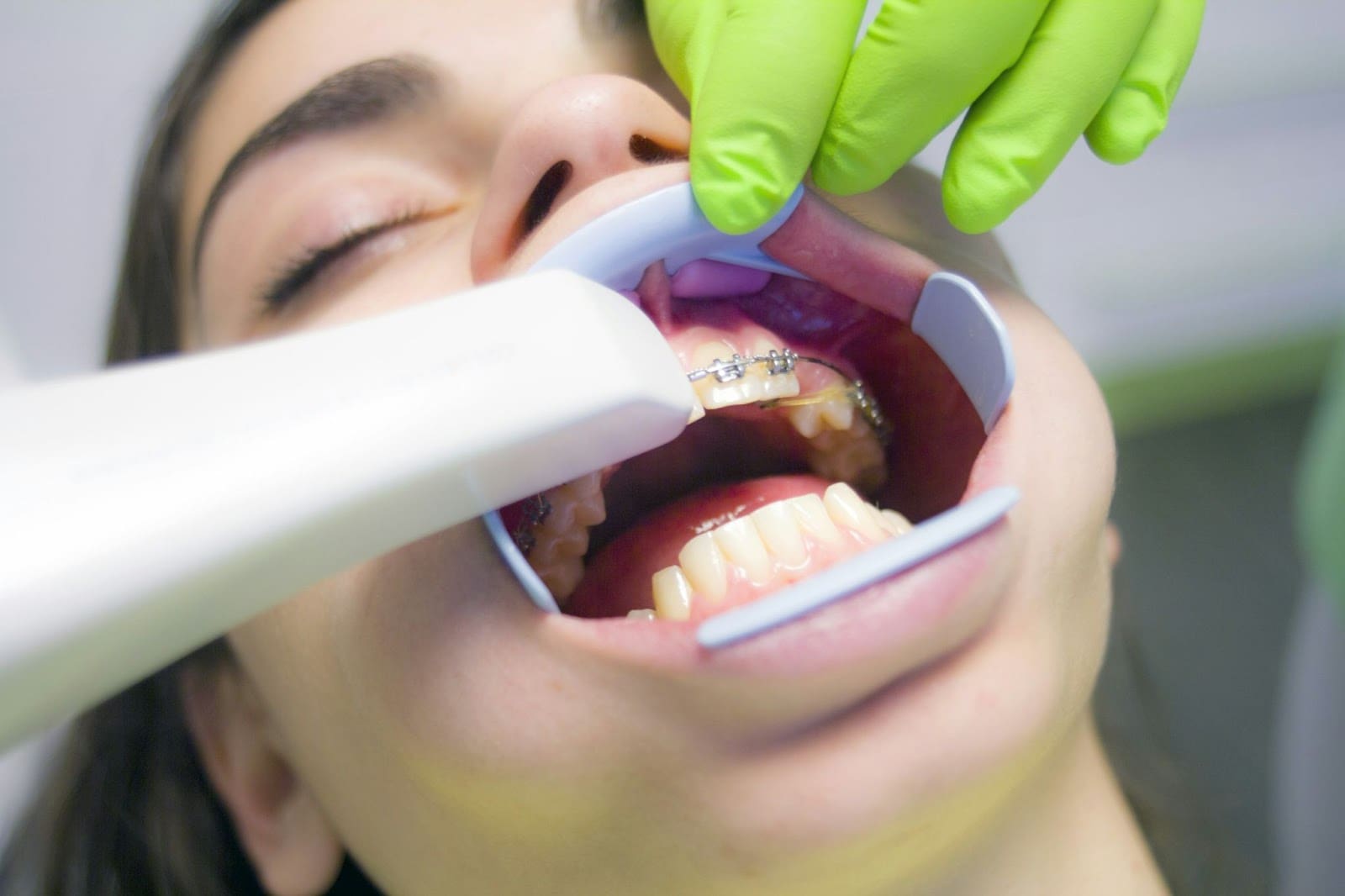 Close up of woman's mouth who is receiving a dgitial dental scan