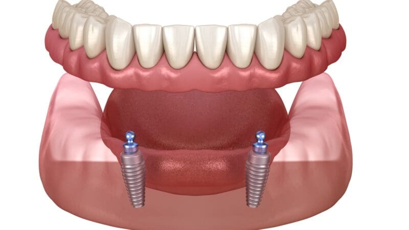 Mandibular removable prosthesis All on 2 system supported by implants with ball attachments. Medically accurate dental 3D illustration