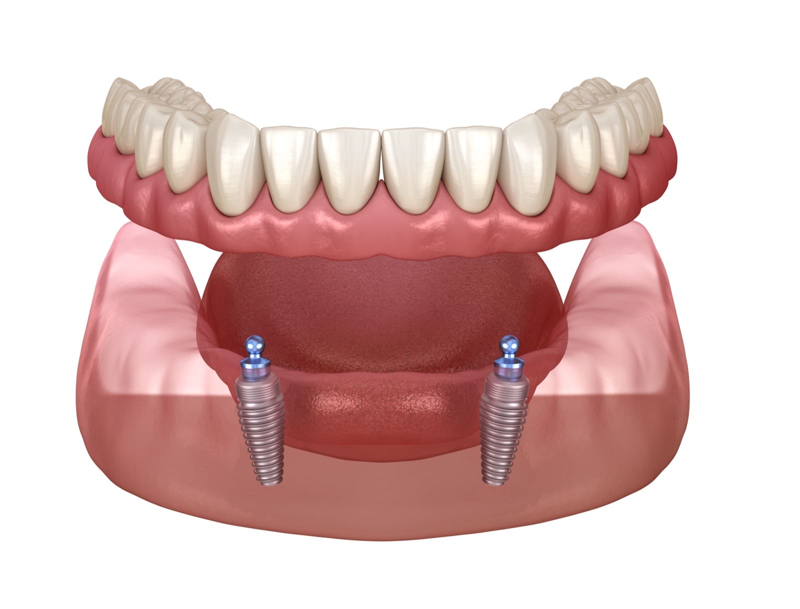 Dentures vs. Dental Implants: Which Is Right for You?
