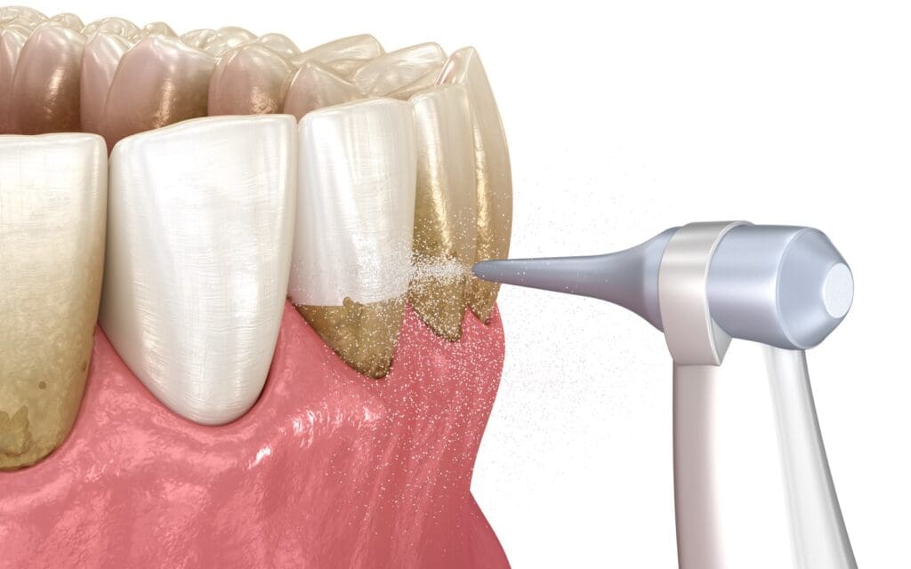 Oral hygiene: Air flow water Teeth Cleaning. Medically accurate 3D installation of human teeth treatment