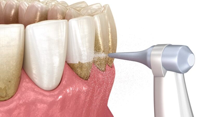 Oral hygiene: Air flow water Teeth Cleaning. Medically accurate 3D installation of human teeth treatment