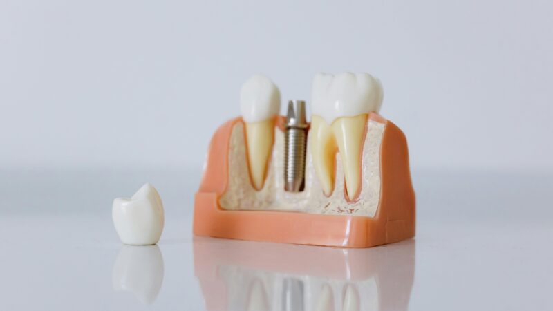 Dental implant model showing tooth replacement