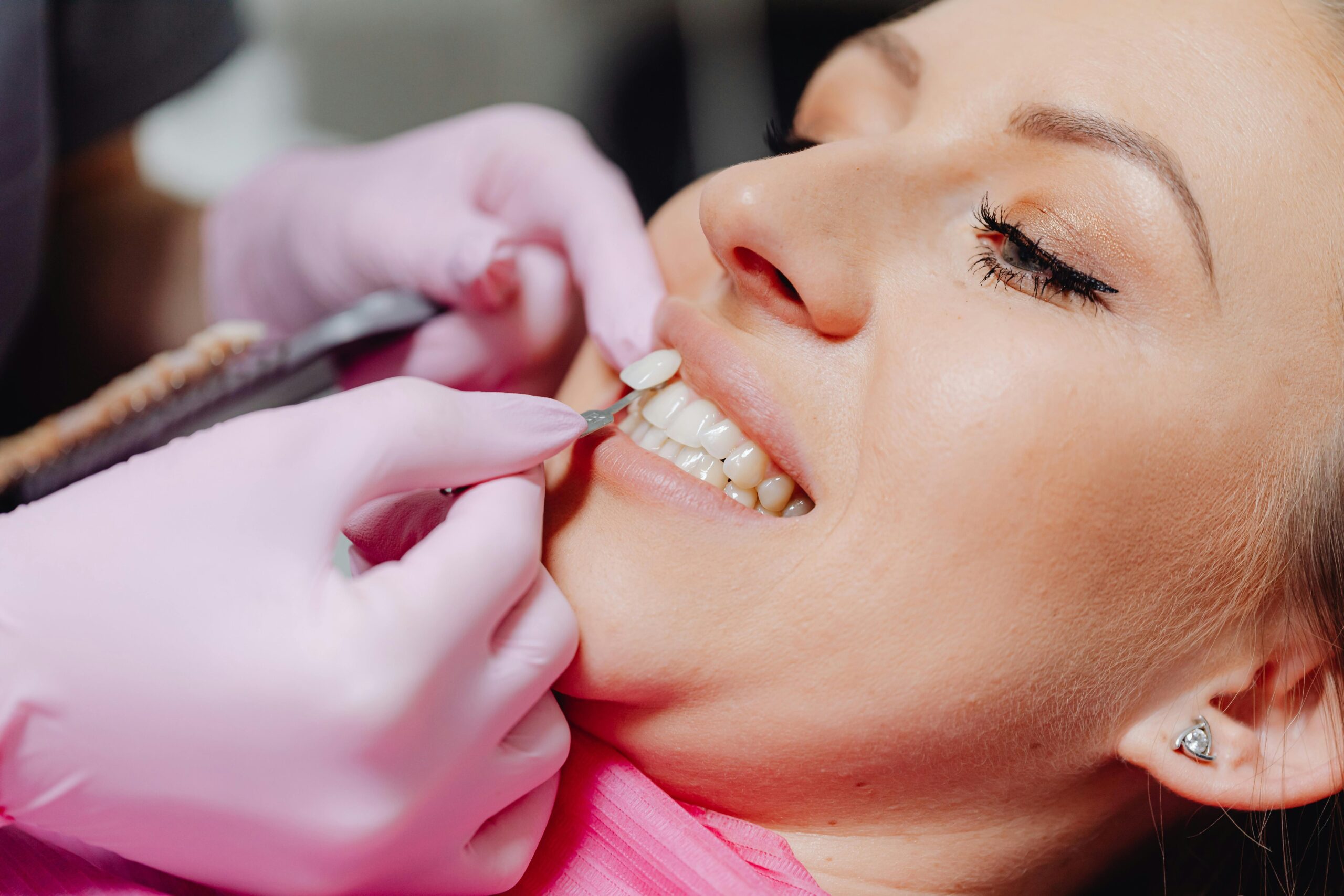 Dental Veneers Cost in Canada: A Complete Price Guide