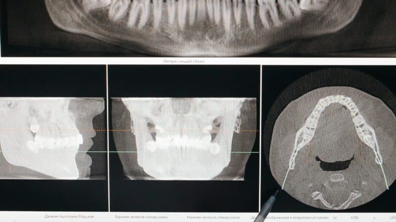 Dental implant model showing implant post and crown