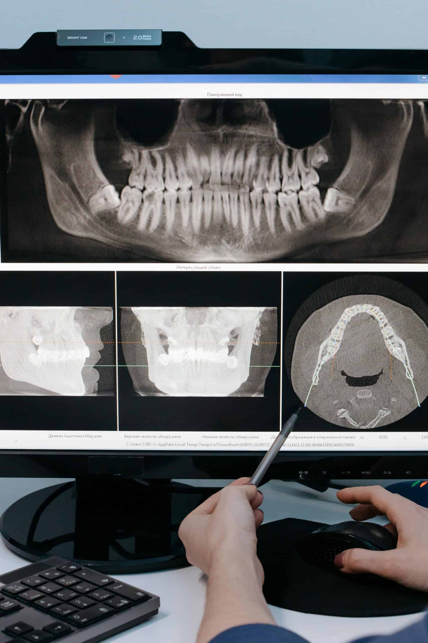 Dental Implants in Canada: What They Cost and What to Know